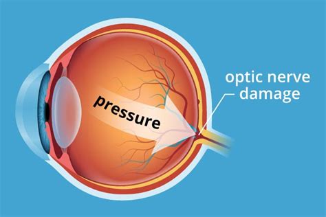 Intraocular Pressure Causes Glaucoma