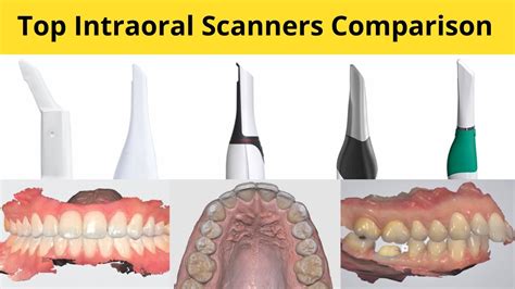Intraoral Scanner Comparison