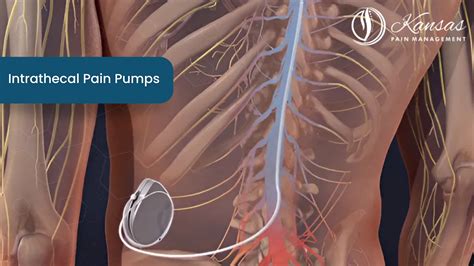 Managing Chronic Pain with Intrathecal Pain Pump Therapy: A Lifeline for Sufferers