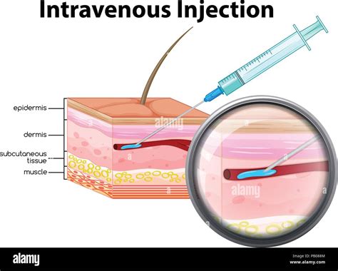 Intravenous Injection