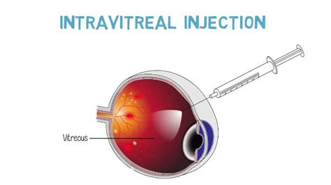 intravitreal avastin injection cpt