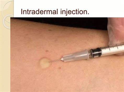 introduction of intradermal injection