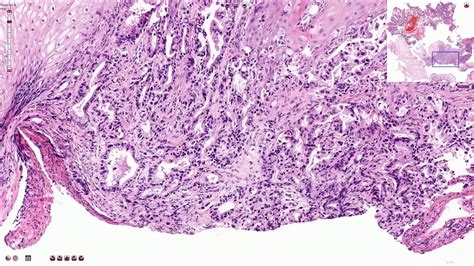 invasive adenocarcinoma esophagus prognosis