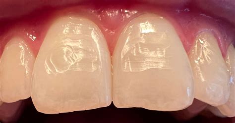 invisalign attachment removal enamel damage