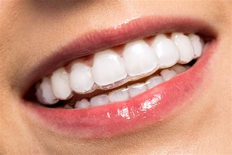 Invisalign Line Braces