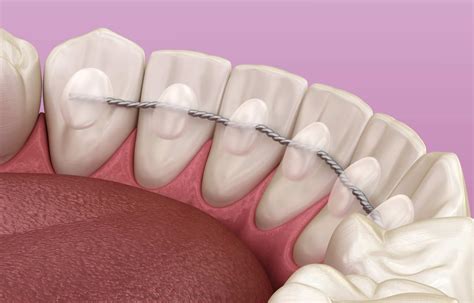 Invisalign Retainer Material
