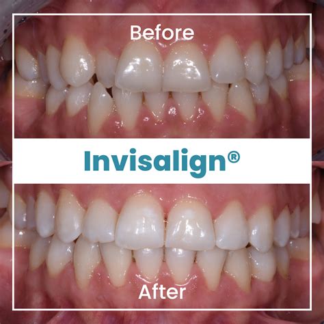 invisalign treatment