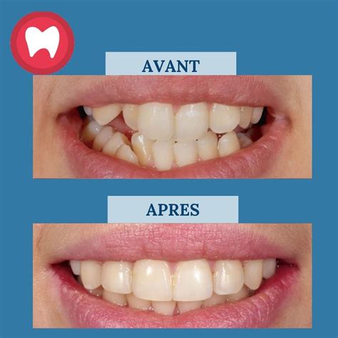 Invisalign® à StLéonard F. Lavoie Orthodontiste