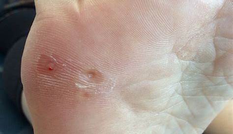 Inward Plantar Wart Treatment Pin By WOLFIESFIGHTERS On Fitness And Workouts
