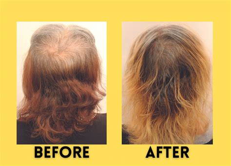 Iodine Supplement For Hair Loss