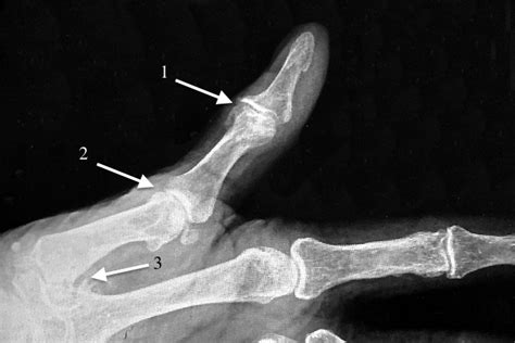 Ip Joint Thumb Oa