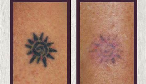 Ipl Tattoo Removal At Home Black Magic Remapolselli