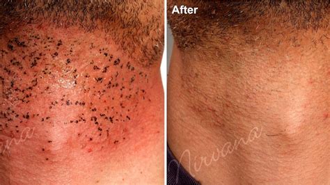 ipl hair removal brazilian before and after