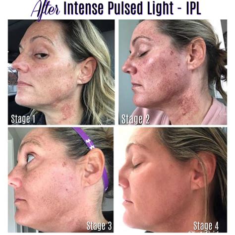 ipl results after 1 treatment