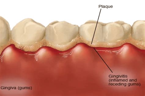 Ipr With Gingivitis