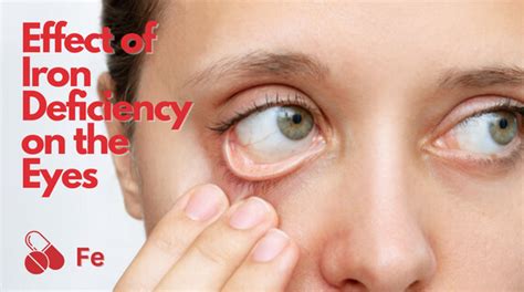 Iron Deficiency Light Headed