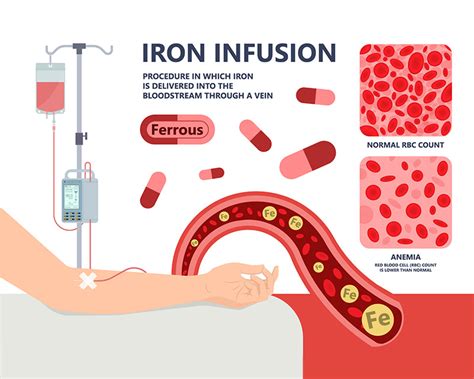 Iron Infusion While Sick