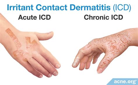Understanding and Managing Irritant Contact Dermatitis: Causes, Symptoms, and Relief