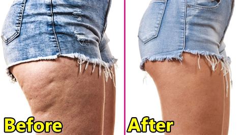 is there a surgery to get rid of cellulite