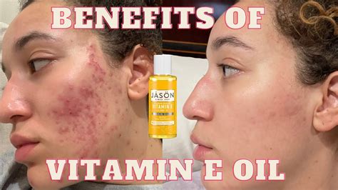 is vitamin e oil good for acne