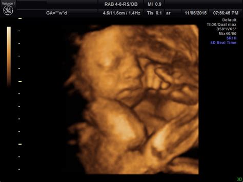 is 3d scan safe during pregnancy
