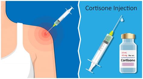 Is A Steroid Injection The Same As A Cortisone Shot