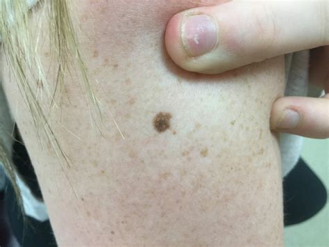 is an atypical mole cancerous