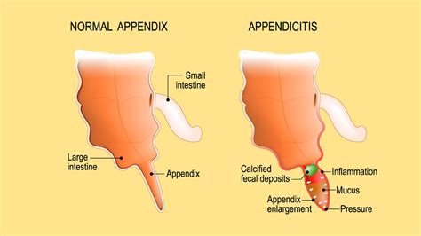 is appendix on right side or left side