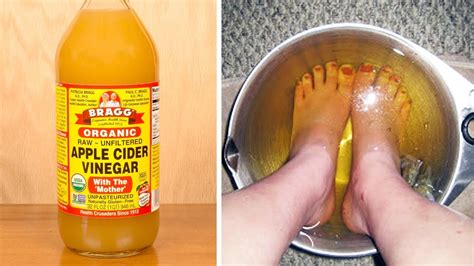 is apple cider vinegar good for soaking feet