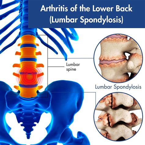 Is Arthritis In Back Curable