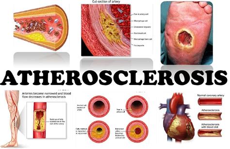 is atherosclerosis a vascular disease