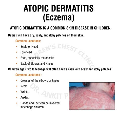 is atopic dermatitis the same as eczematous dermatitis