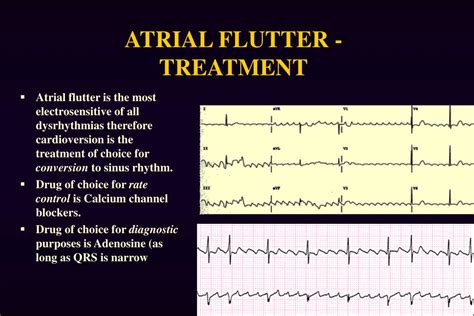 is atrial flutter the same as palpitations