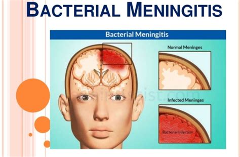 is bacterial meningitis life threatening