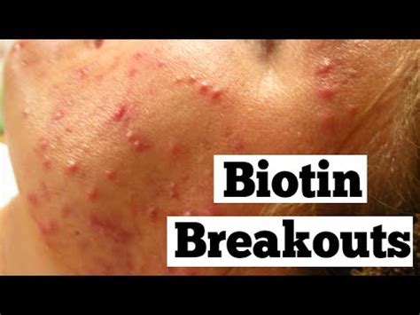 How Biotin Makes Acne Worse in 2020 Vitamins for skin, Acne doctor