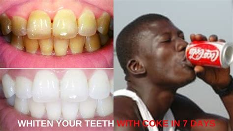 Is Cola Zero Bad For Teeth