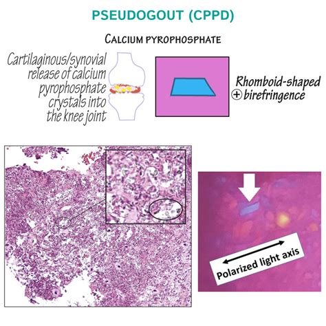 is cppd pseudogout