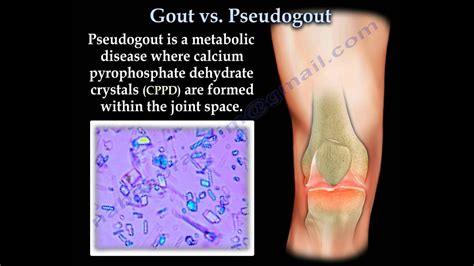 is cppd same as pseudogout