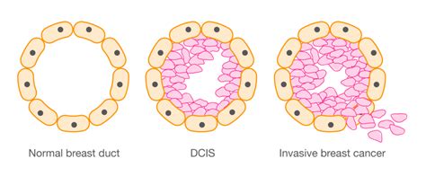 is dcis considered breast cancer