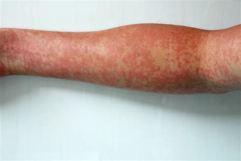 is dengue rash itchy