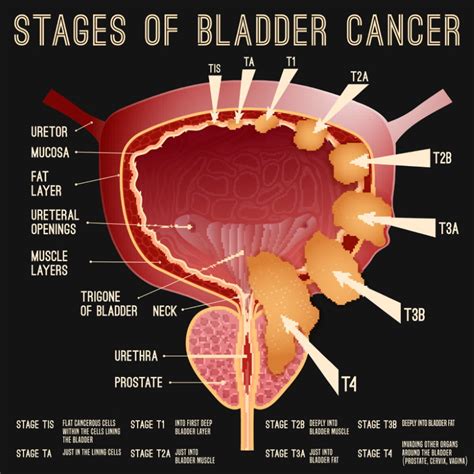 is dying from bladder cancer painful