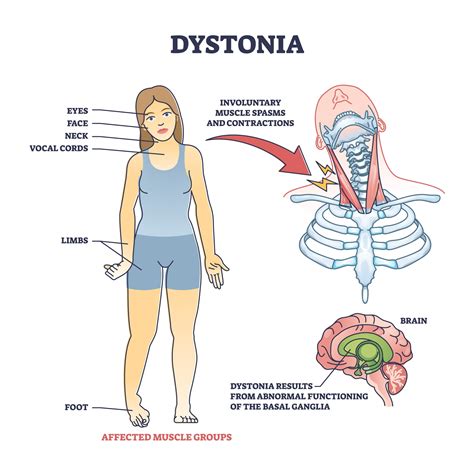 is dystonia a form of parkinson's