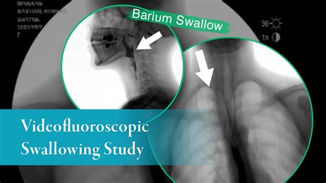 is esophagram and barium swallow the same