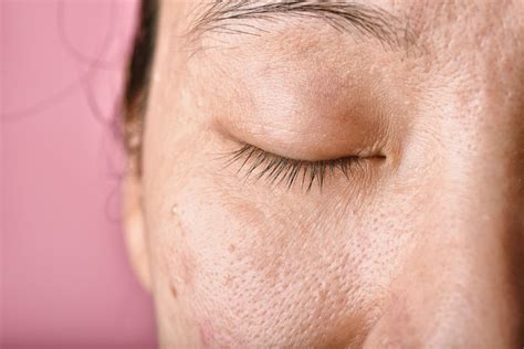 is gua sha good for acne scars