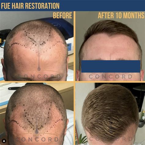 Hair Restoration Photos Melbourne, FL Patient 57533