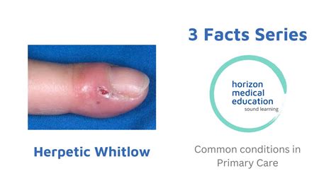 Is Herpetic Whitlow an STD? Uncovering the Facts Behind This Viral Infection