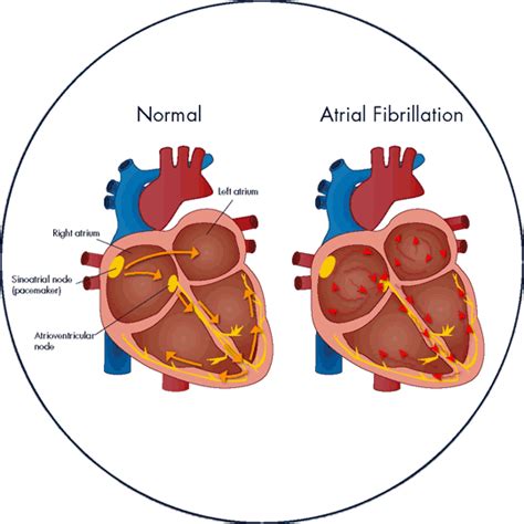 is it normal for afib to come and go