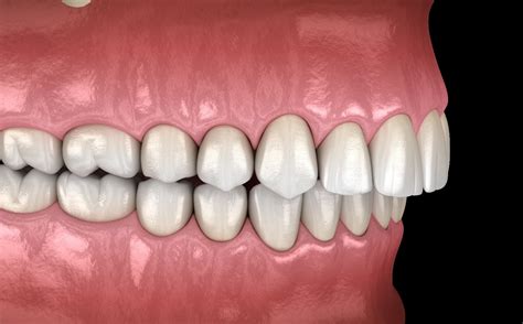is it normal for your bite to be off with invisalign