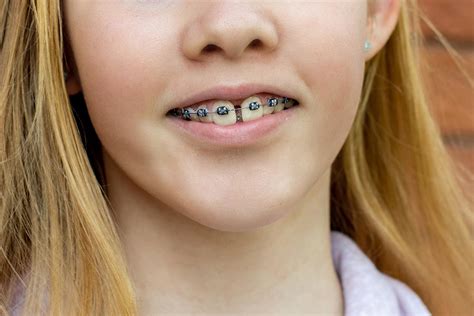 is it normal to get gaps in your teeth with braces