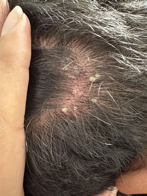 Is It Normal To Get Pimples In Your Scalp